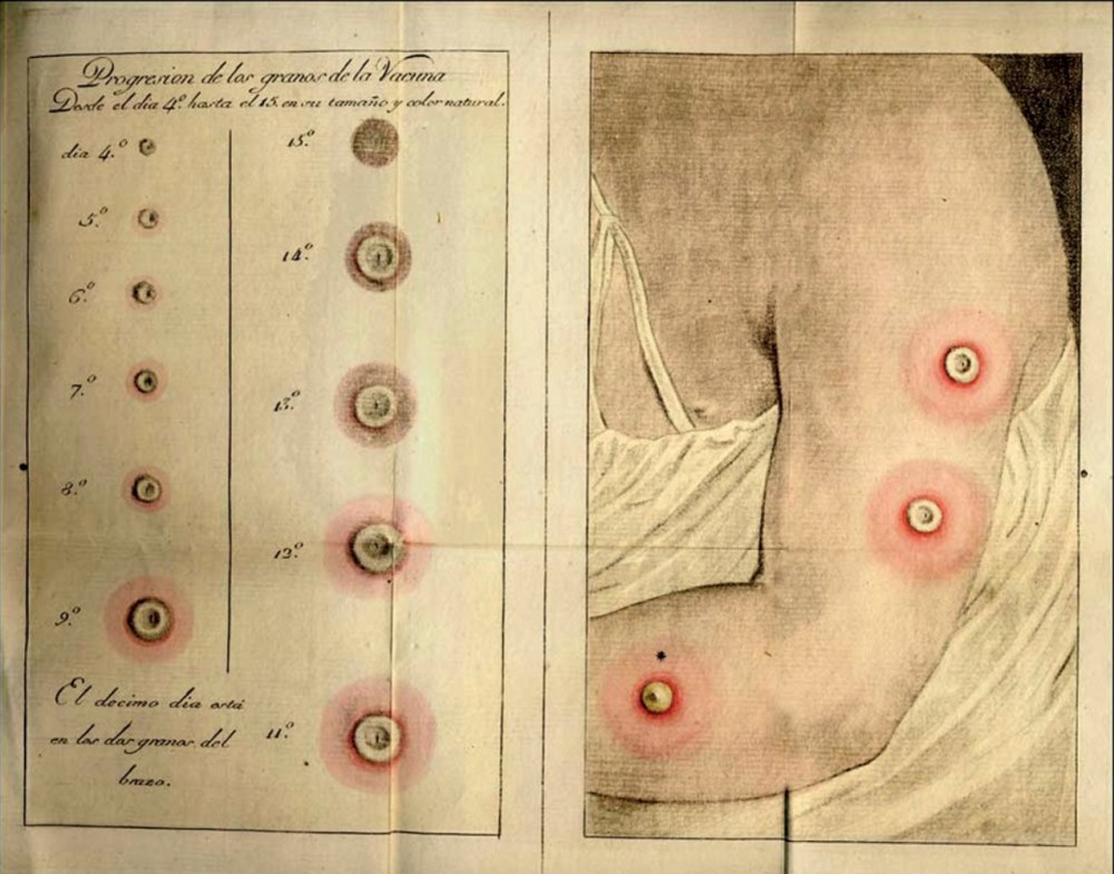 Grabado de José Ximeno Carrera. Progresión de los granos de la vacuna. En Jacques-Louis Moreau de la Sarthe. Tratado histórico de la vacuna. Traducción Francisco Javier Balmis. Madrid. Imprenta Real. 1803. Colección Carlos González Guitián.